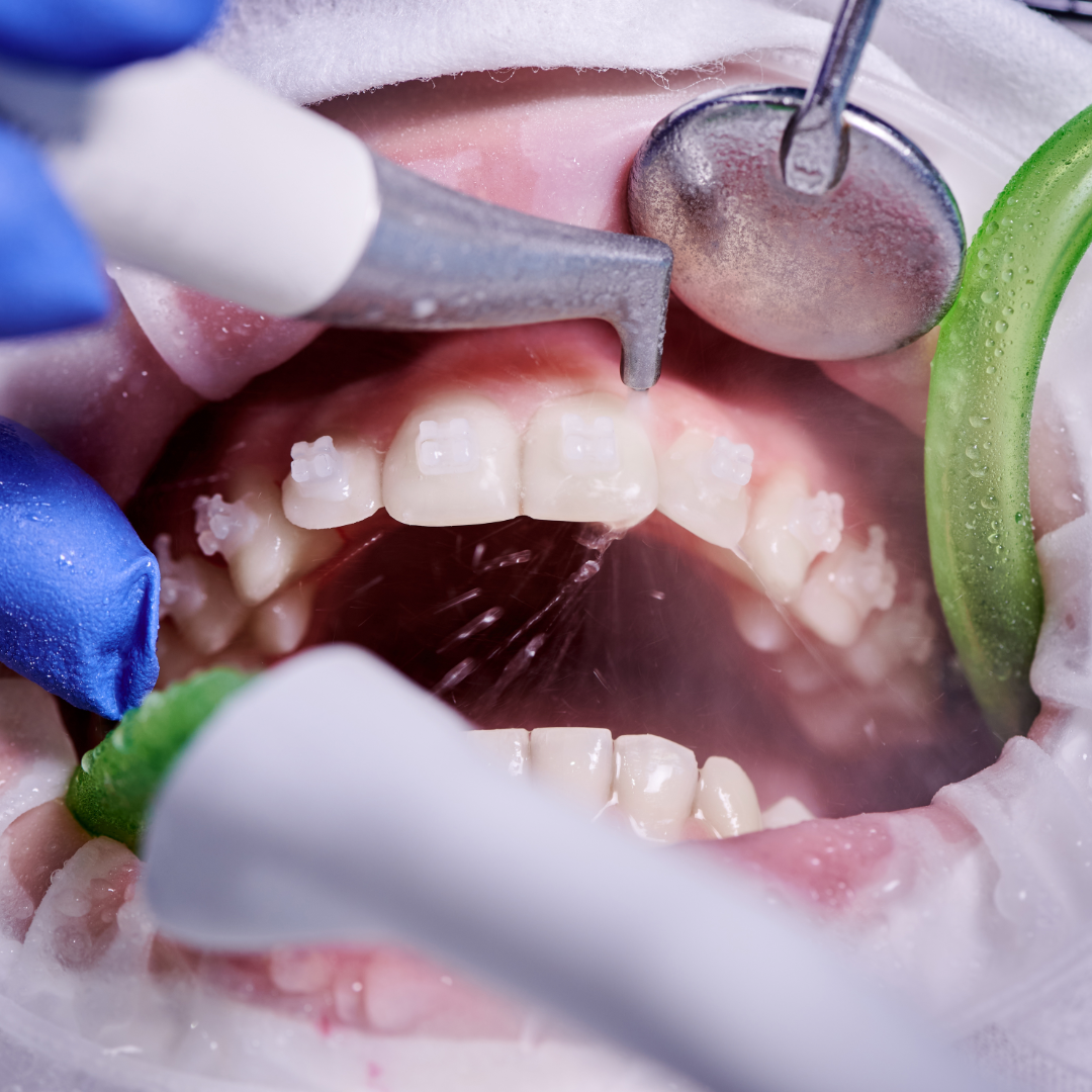 Limpeza Profissional (Profilaxia)