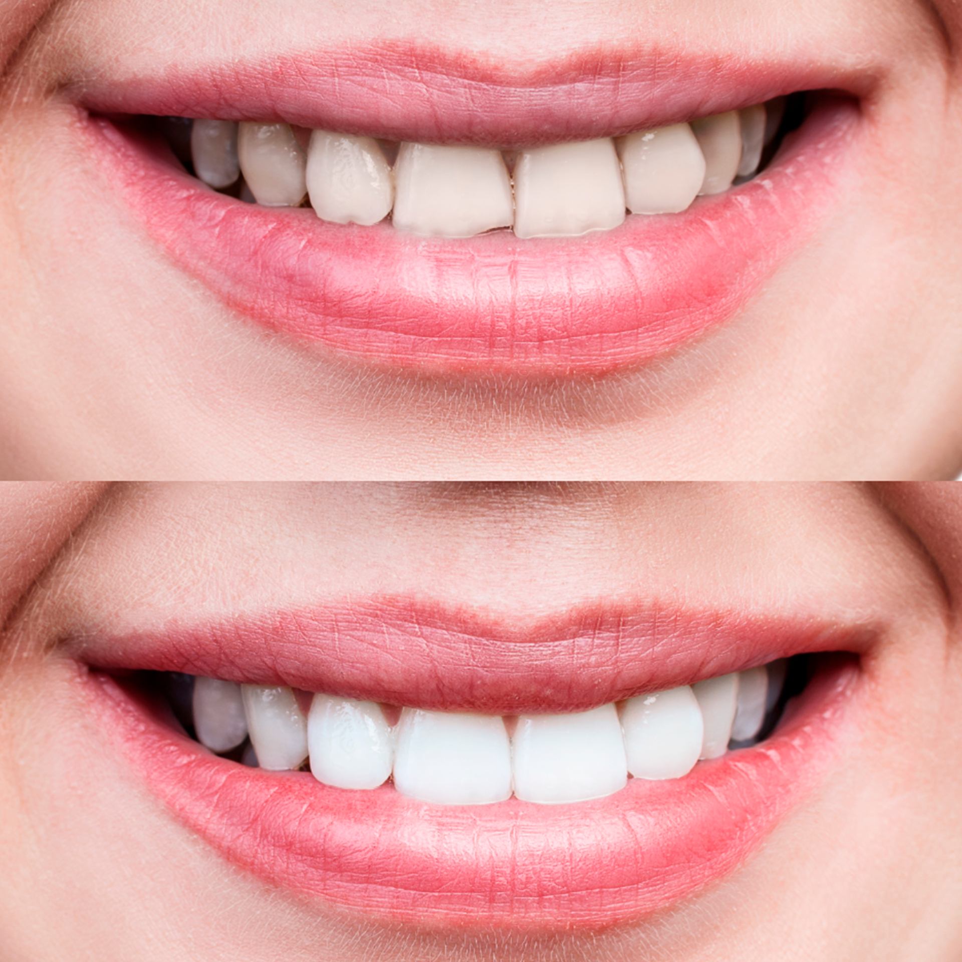 Facetas de Porcelana ou Resina