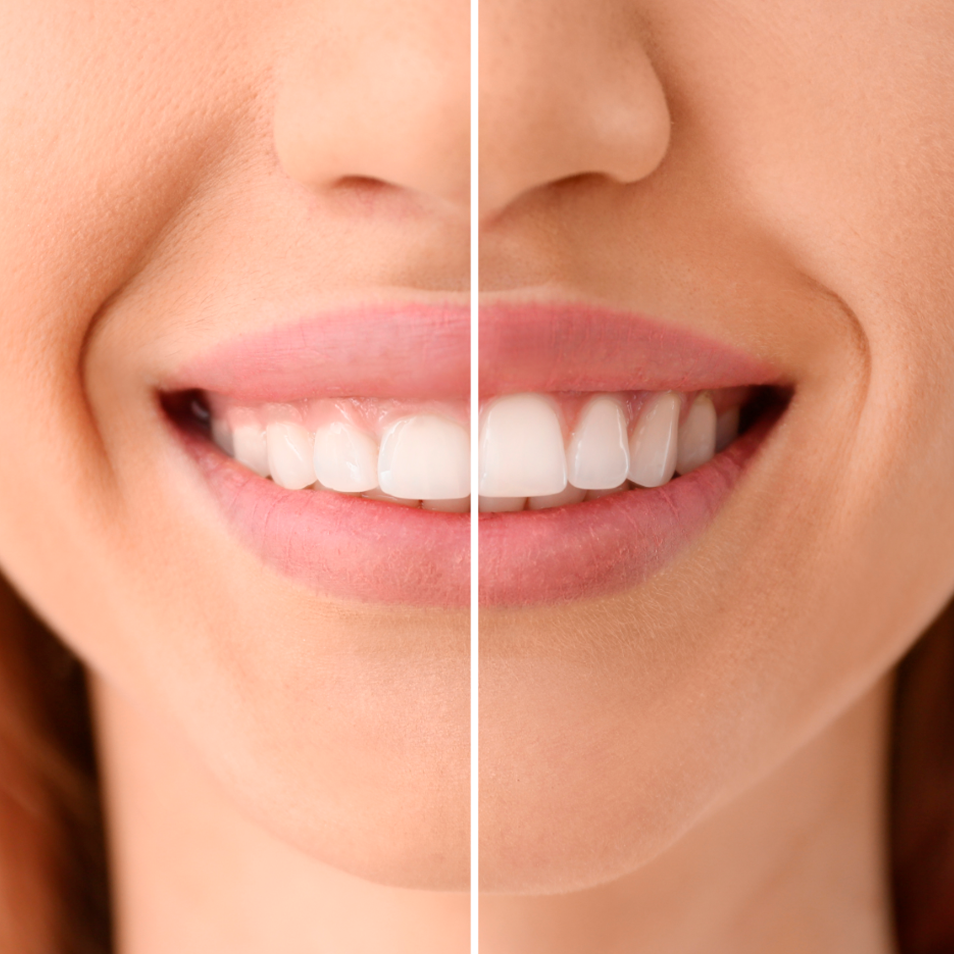 Gengivoplastia