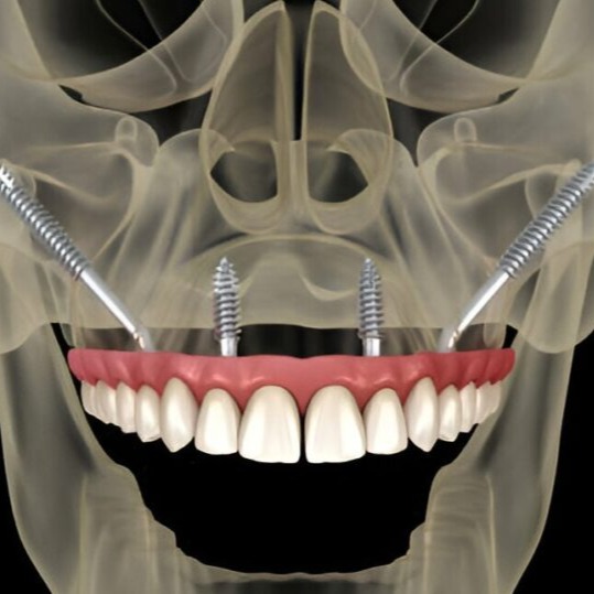 Implantes Zigomáticos
