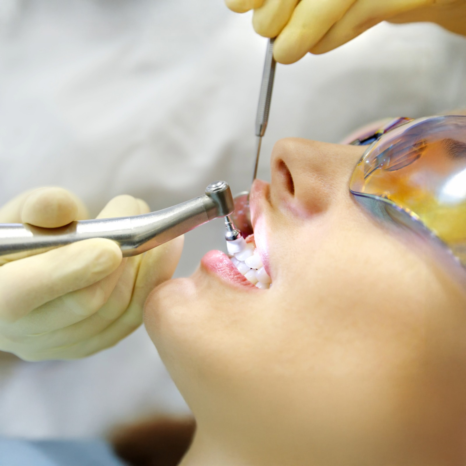 Limpeza Profissional (Profilaxia)