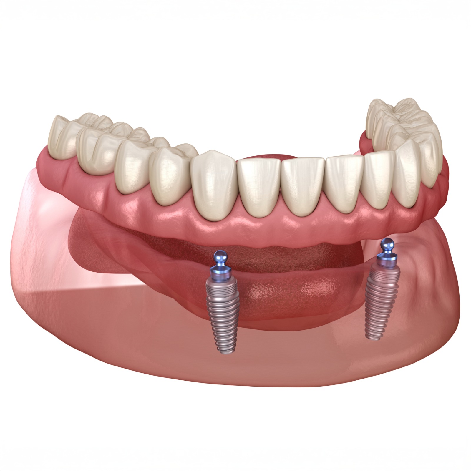 Prótese Overdenture